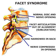 Then proceed to unlock it. Facet Syndrome Dr Russell D Caram Chiropractor