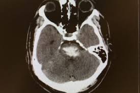 Managing Locked In Syndrome Lessons From A Case Profile Consult Qd