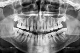 Image result for dental cancer