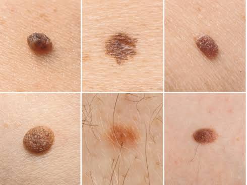 Different Types of Moles | When to Get Checked