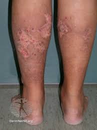 Image result for Calciphylaxis