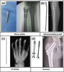 • worn rubber caliper bushings • worn caliper slide rails • improper lubrication more pad less pad uneven wear one side of the pad set Common Medical Devices Used For Fracture Internal Fixation A Bone Download Scientific Diagram