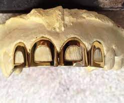 Buy direct from the manufacturer located where custom gold grillz were pioneered in houston, tx. Gold Teeth Dental Single Open Face Permanent Dental Crowns Gold Teeth Dental