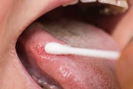 Image result for cancer tongue symptoms)