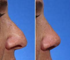 Rhinoplasty Before And After Photos Hooked Nose Rhinoplasty Nose Jobs Rhinoplasty