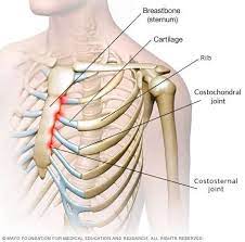 So, use heat for 20 minutes and then. Costochondritis Chest Pain Symptoms And Treatment Patient
