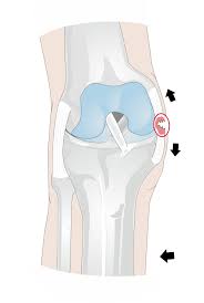This causes prolonged pain and swelling. Medial Collateral Ligament Mcl Injuries My Family Physio