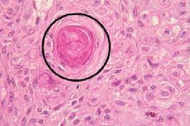 They tend to come in shades of grey, white, black, and. The Rounded Looped Shapes Are Diagnosed As Keratin Pearl Download Scientific Diagram