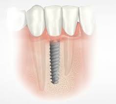 Dental Implant Recovery Time Advanced Dentistry