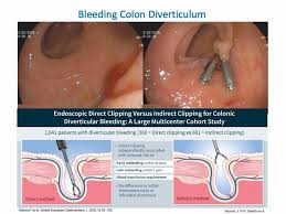 Image result for Diverticular Bleeding
