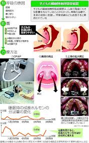 子どもの睡眠時無呼吸症候群 心身発達に重大な影響 Yomidr ヨミドクター 読売新聞