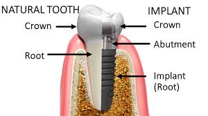 Image result for dental implant