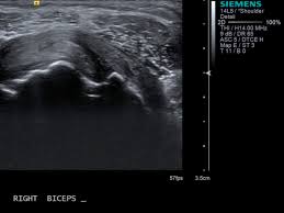 Image result for Biceps Tendon Injection