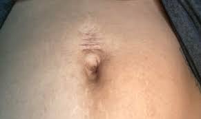 Has Anyone Had Experience Re Piercing Belly Button Scar Tissue It S Been Pierced Before Too Shallow And Jewelry That Was Too Heavy And It Rejected I M Not Worried About The Pain Just More So