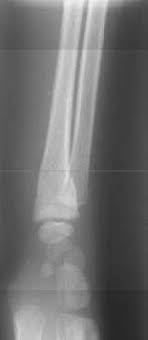 Fracture En Motte De Beurre De La Metaphyse Distale Du Radius Droit 24 Download Scientific Diagram