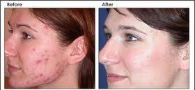 Blue Light Therapy Before After Skin Rejuvenation Acne Skin