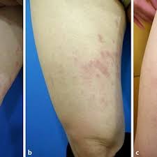 Image result for pruritic urticarial papules and plaques of pregnancy