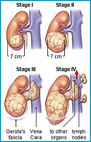 Adakah anda merasa sukar untuk bernafas? Jom Sihat Dengan Herba Tanda Awal Penyakit Buah Pinggang
