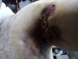 Hidradenitis Suppurativa Hs Nedir Belirtileri Nelerdir Bitkisel Tedavisi