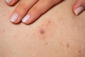 One of the common ways of getting an infected ingrown hair cyst is through touching, picking, pricking or tweezing using dirty sharp objects. Ingrown Hairs Nhs