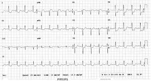 St Elevation In Avr Litfl Ecg Library Diagnosis