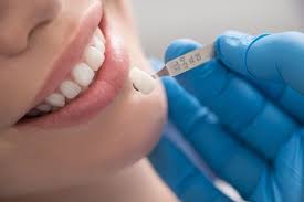 This is longer than the lifespan of composite veneers. How Long Do Dental Veneers Last And How Are They Applied New York Dental Office New York New York