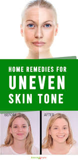 Uneven Skin Tone Get Rids With Natural Remedies In 2020 Natural Skin Toner Uneven Skin Tone Skin Blotches