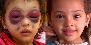 Channel 4 News - The shocking image of her “panda eyes”...