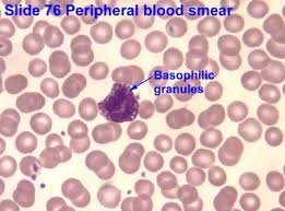 Image result for Peripheral Smear