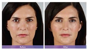 The juvéderm dermal filler treatment process is very quick (about 15 minutes) with immediate results. Juvederm Vollure Xc Tupelo Nasoloabial Injections North Ms Accent Plastic Surgery