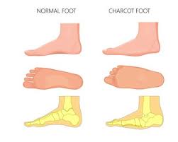 Patients may experience fractures and dislocations of bones and joints with minimal or no known trauma. Charcot Fuss Ursachen Symptome Behandlung Medlexi De