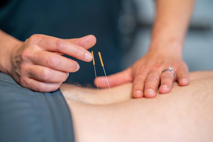 Comparing dry needling and acupuncture at Yuan Qi Acupuncture Center