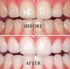 Sound great … indeed, teeth whitening with invisalign is a serious trending topic that many people talk about. Teeth Whitening Certification Live Instructor Online Training Program Launched