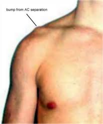 Jul 27, 2017 · another condition that can cause pain under your shoulder blade is liver cancer. In The Corner With The Ring Doc The Separated Shoulder