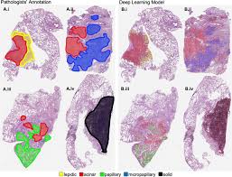Will be diagnosed with lung cancer this year. Deep Learning Model Analyses Lung Cancer Histopathology Slides Physics World