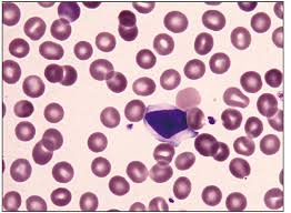 Lymphocyte This Is A Benign Reactive Lymphocyte With Moderately Abundant Pale Gray Cytoplasm Hugging The Surrounding Red Cells And Distinc Hematology Cell Hug