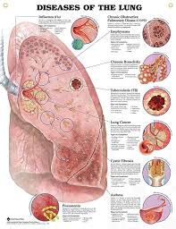 Diseases that attack these organs can cause serious health problems, so the sooner you know about them,. Diseases Of The Lung Anatomy Poster For Medical Office And Classroom Medical Knowledge Pulmonology Medical Education