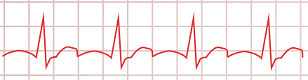 Wer sich nicht schont, läuft. Ekg Grunde Ablauf Auswertung Interpretation Praktischarzt