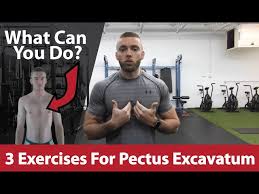Pectus excavatum is a complete or partial depression of the sternum with an associated flattening of the chest, resulting in a reduction in the diameter of the thoracic cavity (fig. 3 Exercises For Pectus Excavatum Youtube