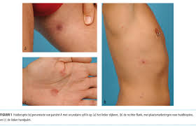 These sores are usually (but not always) firm, round, and painless. Granulomateuze Secundaire Syfilis Nederlands Tijdschrift Voor Geneeskunde