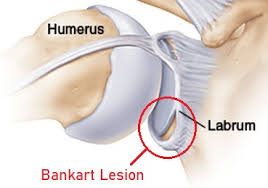 This cartilage encircles the glenoid, a cavity in the shoulder blade. Bankart Lesion Causes Symptoms Treatment