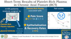 Short-term Results of Platelet-Rich Plasma in the Treatment... : Diseases  of the Colon & Rectum