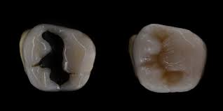 Over time, however, resin composite can stain and become more noticeable. What S The Difference Between Amalgam And Composite Fillings Enlighten Smiles Blog