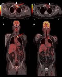 Is it possible to survive thyroid cancer? Surgical Atypical Clavicular Metastasis Of A Thyroid Oncocytoma A Rare Finding