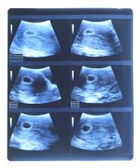 Ultrasonido Bebe Fotos Retratos Imagenes Y Fotografia De Archivo Libres De Derecho Image 15690633