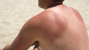 Image result for Sunburn