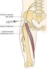 Meralgia paresthetica is a rarely encountered sensory mononeuropathy characterized by paresthesia, pain or sensory impairment along the distribution of the lateral femoral cutaneous nerve caused by entrapment or compression of the nerve as it crosses the anterior superior iliac spine and runs beneath the inguinal ligament. 57 Lateral Femoral Cutaneous Neuropathy Clinical Gate