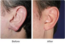 Here's a guide to help y. Sale Ear Plastic Surgery Near Me Is Stock