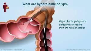 You'll begin the exam lying on your side on the exam table, usually with your knees drawn toward your chest. When Should I Get A Colonoscopy And What Do The Results Mean Youtube
