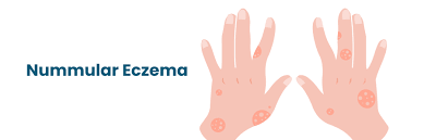 Image result for Eczema nummulare